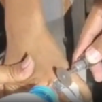 Bocah Jember Tersangkut Tutup Parfum, Damkar Bertindak