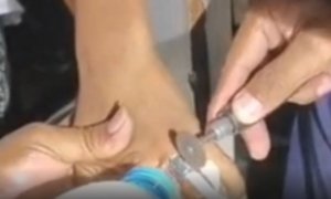 Bocah Jember Tersangkut Tutup Parfum, Damkar Bertindak