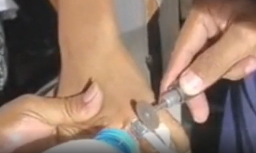 Bocah Jember Tersangkut Tutup Parfum, Damkar Bertindak