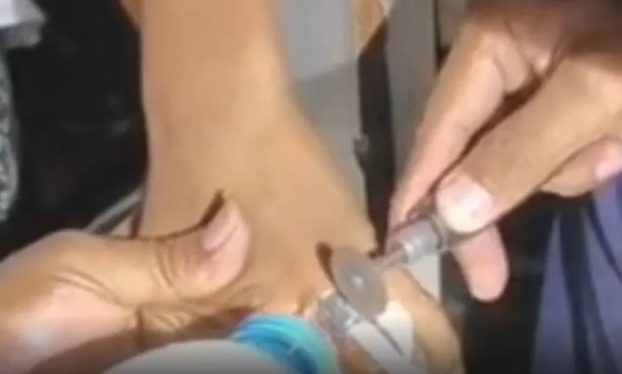Bocah Jember Tersangkut Tutup Parfum, Damkar Bertindak
